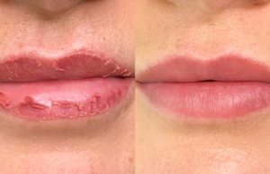 Healing Lips- Lip Balm for Soothing Dry, Cracked Skin